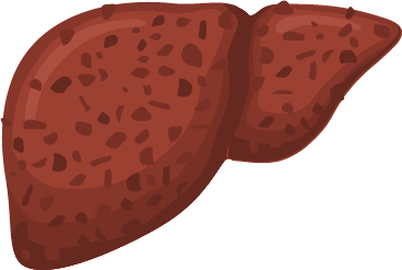 Fibrosis–chronic cholestasis leads to fibrosis and cirrhosis 