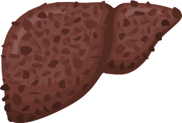 Cirrhosis–a permanently damaged cirrhotic liver may require transplant 