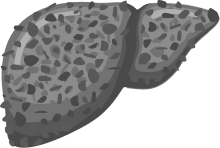 Liver failure–progression to liver failure and death