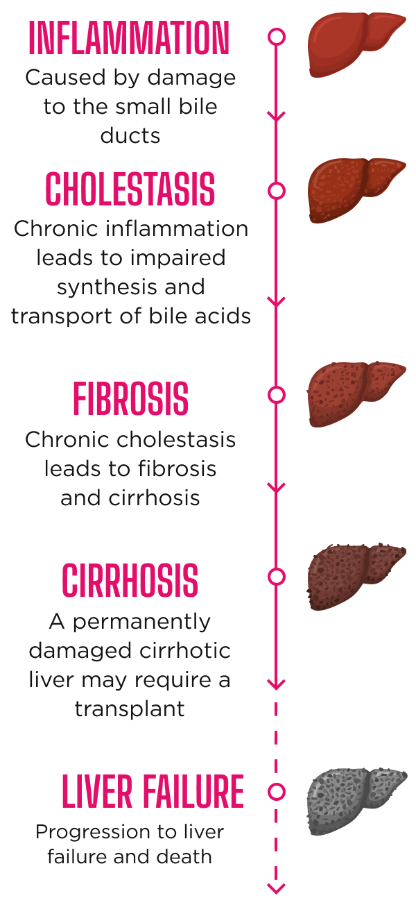 Inflammation, cholestasis, fibrosis, cirrhosis, liver failure