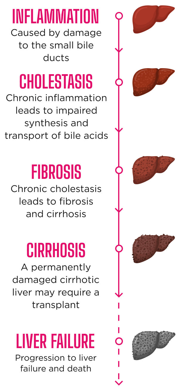 Inflammation, cholestasis, fibrosis, cirrhosis, liver failure